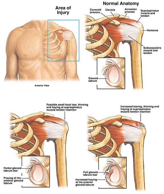 Can A Car Accident Cause A Rotator Cuff Tear? 3 rotator cuff tear car accident settlement min