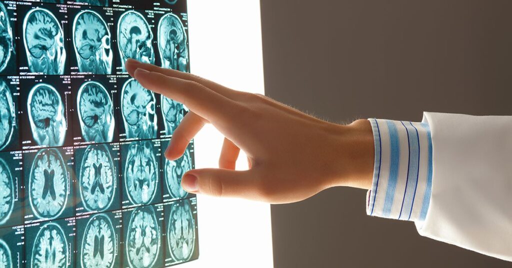 Can A Car Accident Cause White Matter Disease? 15 traumatic brain injuries nebraska