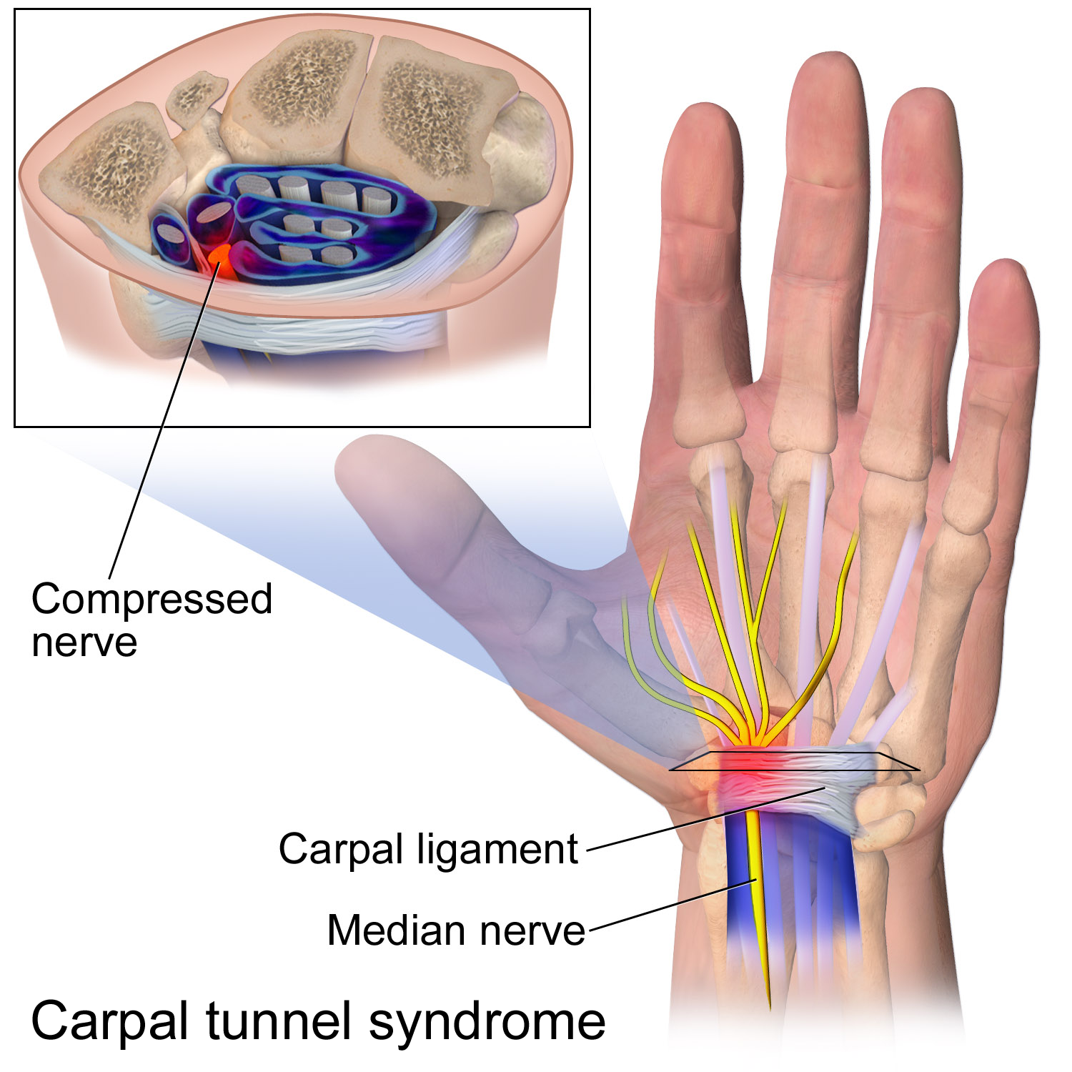 Can A Car Accident Cause Carpal Tunnel Syndrome? 1 Can a Car Accident Cause Carpal Tunnel Syndrome?